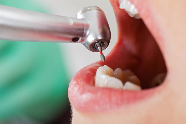 Best Emergency Dental Care for Broken or Chipped Teeth in Crow Agency, MT